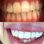 Charger l'image dans la galerie, Dentifrice blanchissant probiotique Gestion de la santé bucco-dentaire(Élimine des années de taches)
